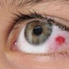 Лечение травмы глаз